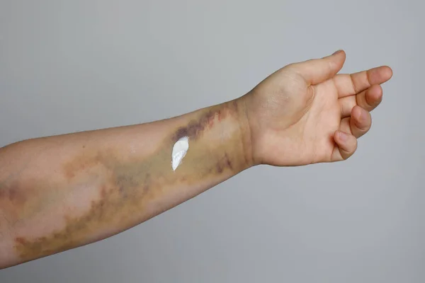 White medical cream on female skin with bruise after trauma injury