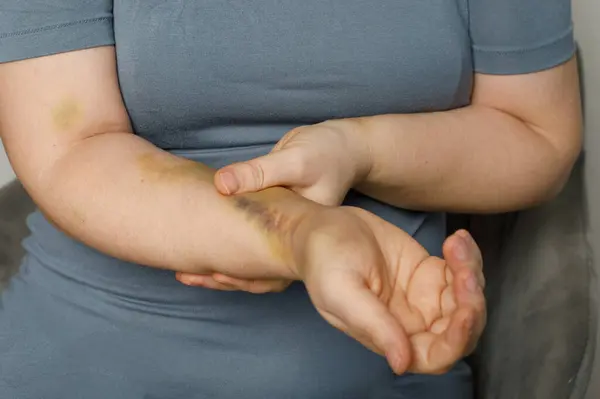 Mão Humana Com Hematoma Acidente Carro — Fotografia de Stock