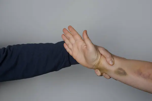 Mão Humana Com Hematomas Violência Doméstica Conceito Abuso — Fotografia de Stock