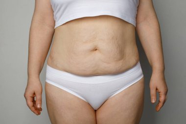 Çizgili ve aşırı kilolu bir kadın midesi.