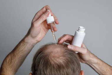Serum peptitli keltoş adam ya da Minoxidil yakın plan. Saç dökülmesi ve saç dökülmesi konsepti.