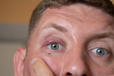 Gözün arkasındaki Chalazion Evely 'nin enfeksiyonu  