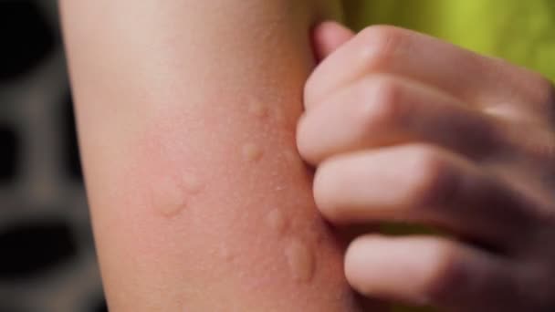 Allergy Injection Skin Man Hand Close Selective Focus — Αρχείο Βίντεο