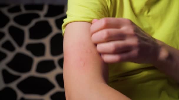 Allergisymtom Efter Injektion Ödematös Del Rött Punkteringsställe — Stockvideo