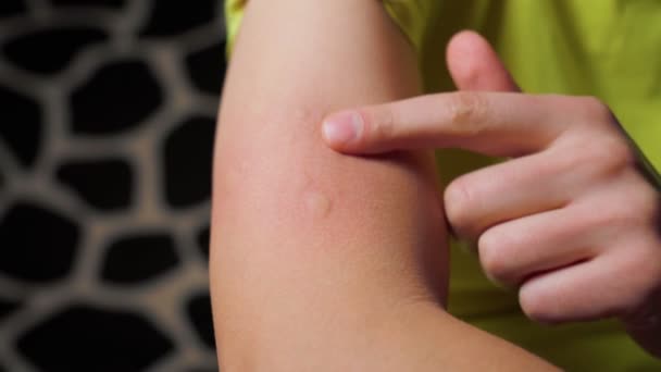Allergische Symptomen Injectie Edemateus Deel Rode Punctieplaats — Stockvideo
