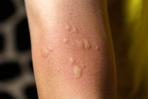 Tekstura Skóry Strzał Alergii Chwasty Reakcja Objawy Alergii Skupienie Selektywne — Zdjęcie stockowe