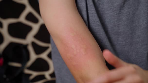 Симптомы Аллергии После Инъекции Отвратительная Часть Место Красной Пункции — стоковое видео