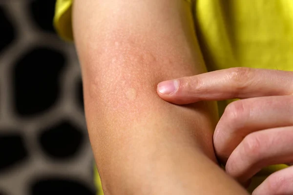 Allergy Symptoms Injection Edematous Part Red Puncture Site — стоковое фото