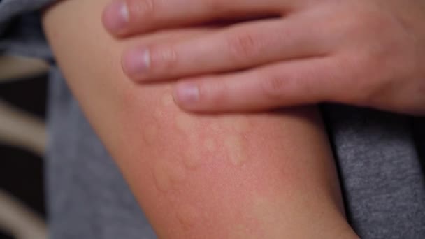 Skin Man Suffering Severe Urticaria Heaven Kaligata Allergy Symptoms — Stock Video