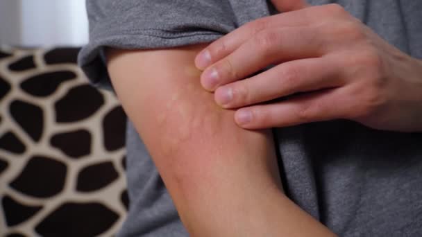 アレルギーからの注射後の人間の腕の中でのワクチン反応 腫れた部分 赤い穿刺部位 誰も知らない — ストック動画