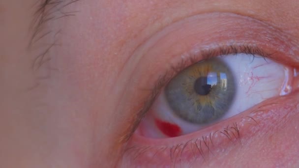 Fechar Perto Olho Homem Sangue Hemorragia Olho Ruptura Vaso Olho — Vídeo de Stock