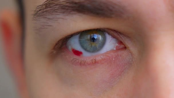 ブラッドショットの目 赤く出血する眼球だ 出血する目の怪我 選択的なフォーカス — ストック動画
