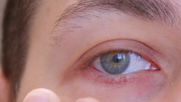 Gözü Kanlı Bir Adama Yaklaş Göz Kanaması Gözdeki Damar Yırtılması — Stok video