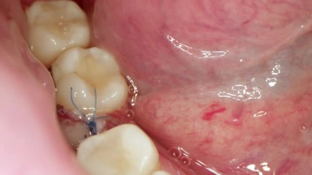 Close Cavidade Oral Paciente Que Acabou Ter Aumento Gengiva Para — Vídeo de Stock