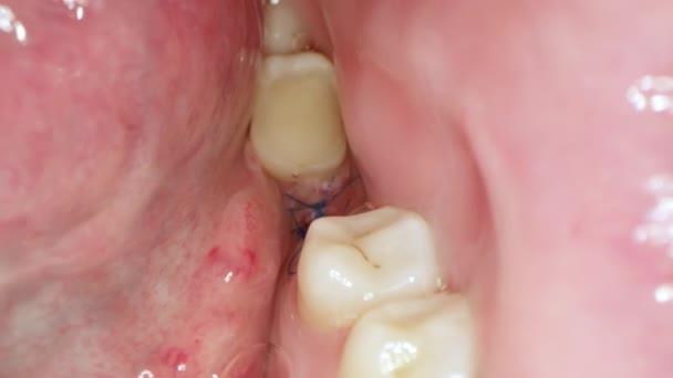 インプラント配置のためのガム増強を受けたばかりの患者の閉鎖口腔で 黒い糸で患者の歯茎を保護し 骨の成長を増加させます インプラントを設置するプロセス — ストック動画