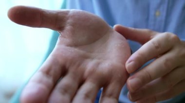 Dermatolojik tedavi gerekiyor. Alerjisi olan erkek elleri, ellerinde soyuluyor. Avuçlarda çok kuru, çatlamış deri, sorunlu deri. 4K.