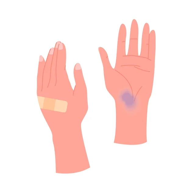 Lidské Ruce Náplastí Modřiny Dlani Infografické Vektorové Znázornění Karikatura Izolované — Stockový vektor