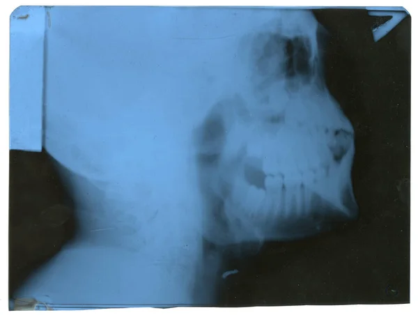 Head x-ray for medical diagnosis.