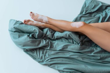Vitiligo kronik deri hastalığı olan bir kadının gri bir battaniyenin üzerinde oturması. 