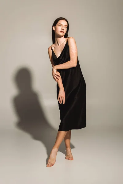 Mujer Bonita Con Vitiligo Posando Vestido Negro Sobre Fondo Gris —  Fotos de Stock