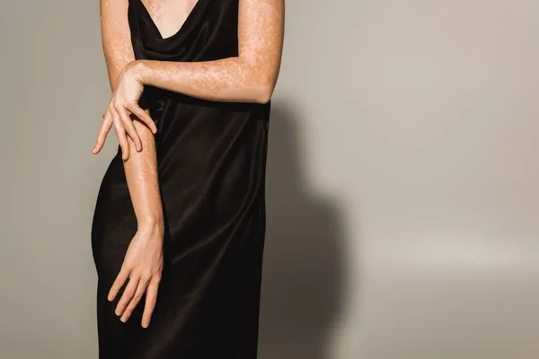 Ausgeschnittene Ansicht Der Frau Mit Vitiligo Berühren Arm Auf Grauem — Stockfoto