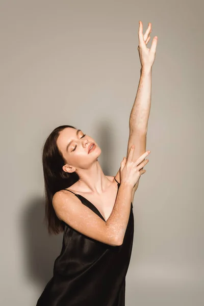 Brunett Kvinna Med Vitiligo Poserar Silke Klänning Grå Bakgrund — Stockfoto