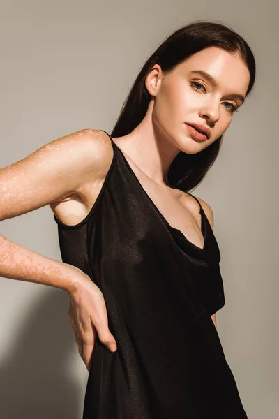 Fashionabla Ung Kvinna Med Vitiligo Poserar Sidenklänning Grå — Stockfoto