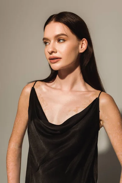 Vacker Kvinna Med Vitiligo Tittar Bort Medan Poserar Grå Bakgrund — Stockfoto