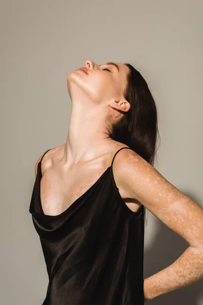 Ung Modell Med Vitiligo Poserar Svart Kamisol Grå Bakgrund — Stockfoto