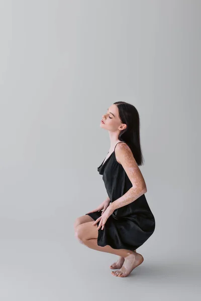 Pretty model with vitiligo in satin dress posing on grey background