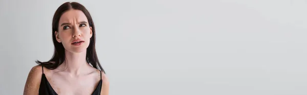 Задумчивая Модель Витилиго Глядя Сторону Изолированы Серый Копировальным Пространством Баннер — стоковое фото
