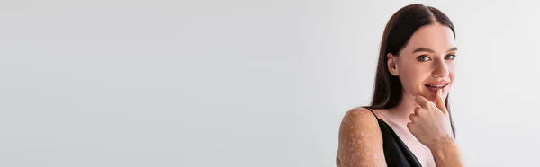 Mooie Vrouw Met Vitiligo Aanraken Lip Geïsoleerd Grijs Met Kopieerruimte — Stockfoto