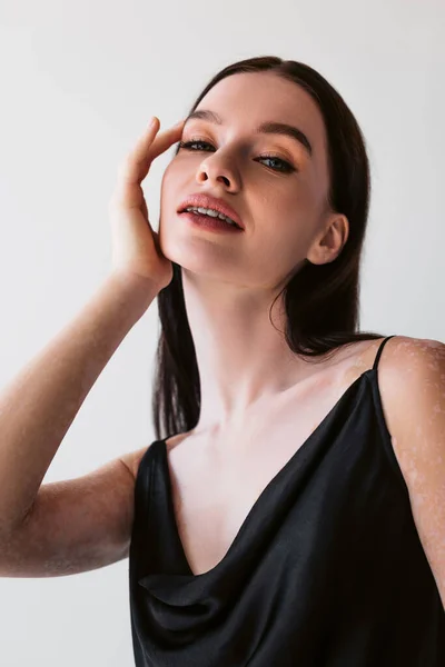 Retrato Mujer Morena Bonita Con Vitiligo Tocando Cara Aislada Gris —  Fotos de Stock