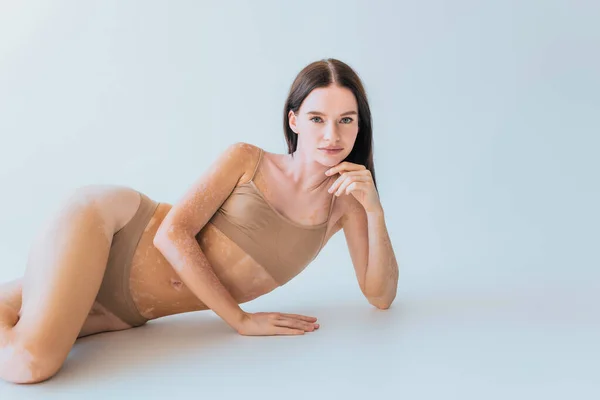 Brunett Modell Med Vitiligo Ligger Beige Övredel Med Trosor Grå — Stockfoto