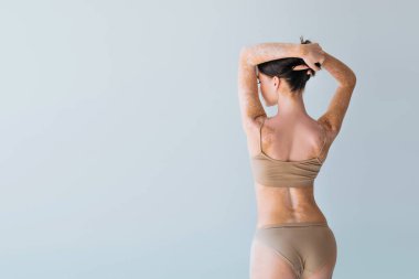 Vitiligo 'lu genç bir kadın bej iç çamaşırlarıyla dikiliyor ve gri saçlarını düzeltiyor.