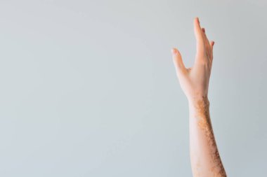 Vitiligo gri renkte izole edilmiş zarif kadın eli manzarası.