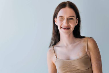 Mutlu genç kadın vitiligo ve diş telleri ile Gri üzerinde izole edilmiş.