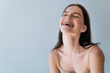 Vitiligo 'su ve diş telleri olan mutlu genç bir kadın. Gri üzerinde tek başına gülüyor.