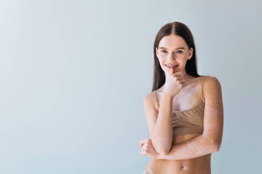 Neşeli, vitiligo ve diş telleri olan genç bir kadın griye gömülmüş gülümsüyor.