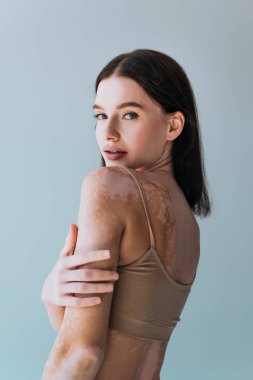 Vitiligo 'lu esmer kadının portresi. Gri renkli kameraya bakıyor.
