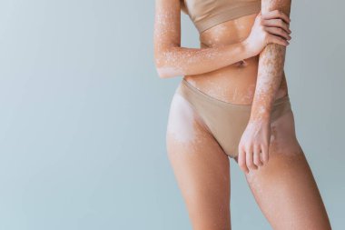Gri üzerinde vitiligo derisi olan bej renkli iç çamaşırlı genç kadın görüntüsü.