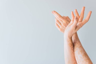 Vitiligo 'lu genç kadın elleri gri renkte izole edilmiş.
