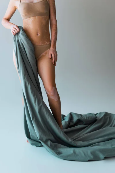 Vista Cortada Mulher Com Condição Pele Vitiligo Segurando Cobertor Enquanto — Fotografia de Stock