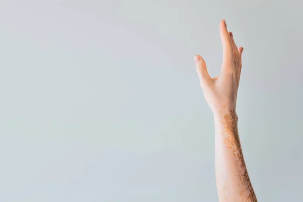 Abgeschnittene Ansicht Der Eleganten Weiblichen Hand Mit Vitiligo Isoliert Auf — Stockfoto