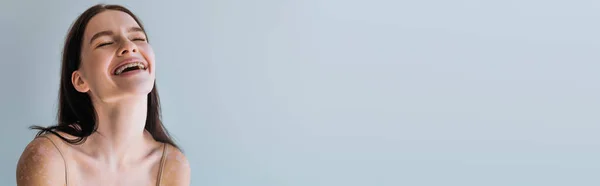 백반증 회색에 고립된 채웃고 현수막 — 스톡 사진