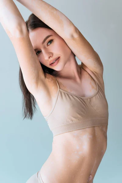 Mujer Joven Con Vitiligo Posando Con Las Manos Levantadas Mirando — Foto de Stock