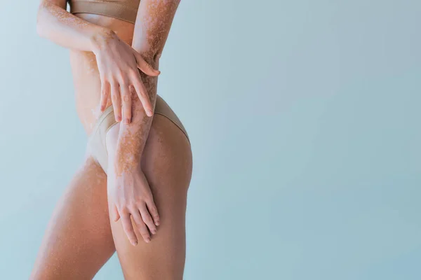Seitenansicht Der Beschnittenen Jungen Frau Mit Vitiligo Steht Höschen Isoliert — Stockfoto