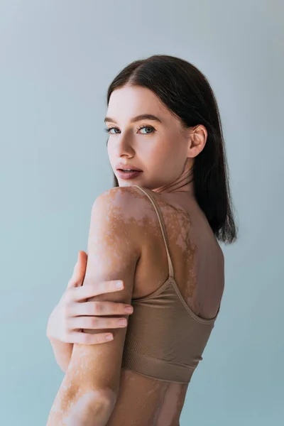 Retrato Jovem Morena Com Vitiligo Olhando Para Câmera Isolada Cinza — Fotografia de Stock