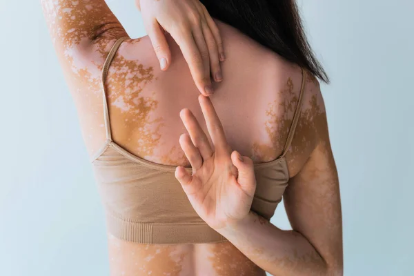 Back View Brunette Woman Vitiligo Touching Fingers Isolated Grey — стоковое фото
