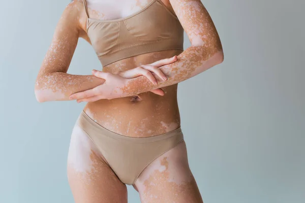 Çamaşırlı Vitiligo Derili Gri Üzerinde Duran Poz Veren Genç Kadının — Stok fotoğraf
